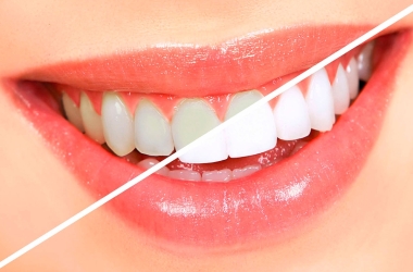 Clareamento dental: descubra tudo sobre esse tratamento