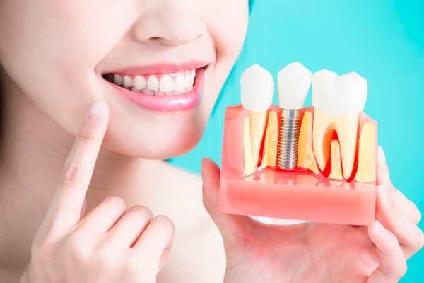 Vantagens do implante dentário para sua saúde bucal