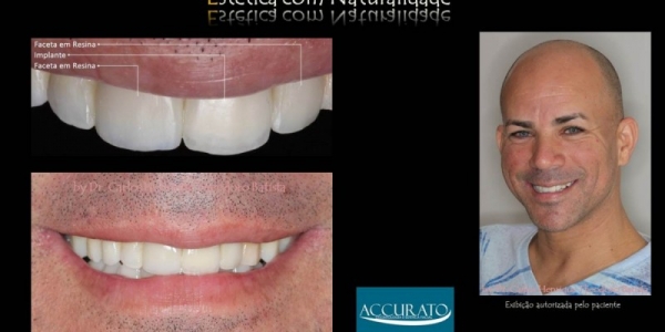 Implante Dentário em Dente da Frente