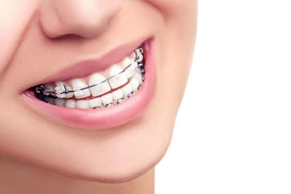 Aparelho dental: descubra os diferentes modelos e suas funções